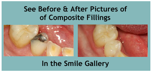 composite fillings honolulu