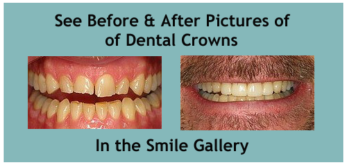 dental crowns in honolulu hi
