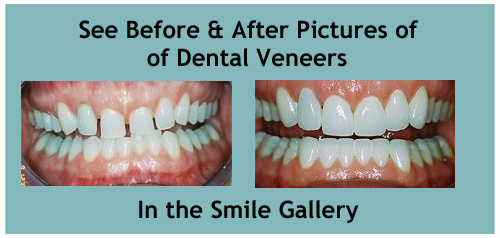 dental veneers in honolulu hi