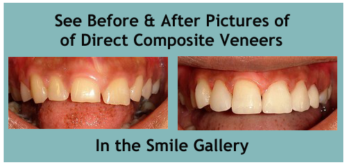 honolulu dental veneers