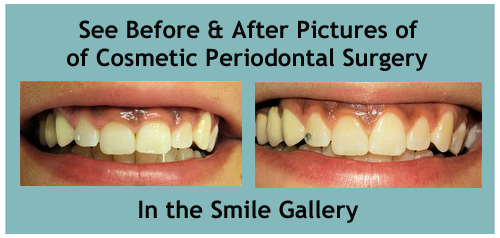 cosmetic periodontal surgery periodontal surgery