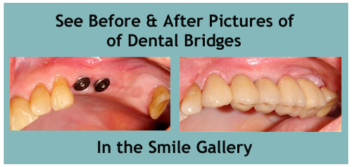 dental bridges in honolulu hi